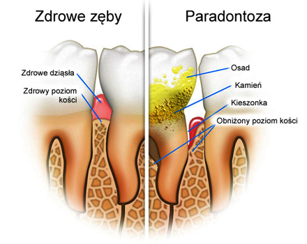 leczenie paradontozy stargard