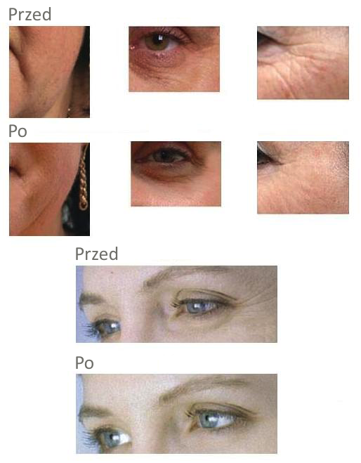 mezoterapia stargard