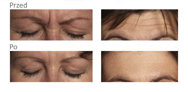 botox stargard